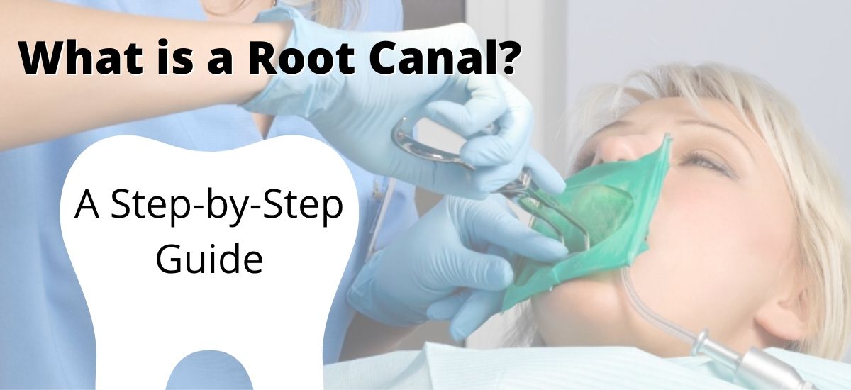 What is a Root Canal? A Step-by-Step Guide